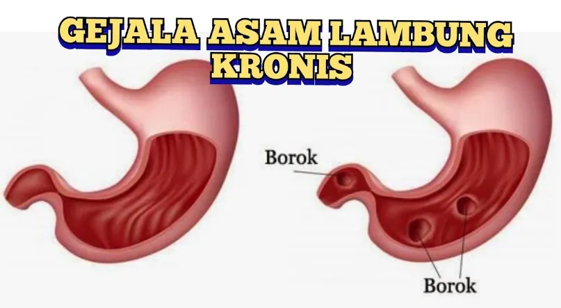 Cara Ampuh Mengatasi Asam Lambung
